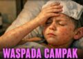 Waspada, Ancaman Penyakit Campak Di Lampura